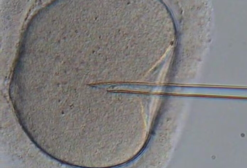 ICSI or Intra-Cytoplasmic Sperm Injection